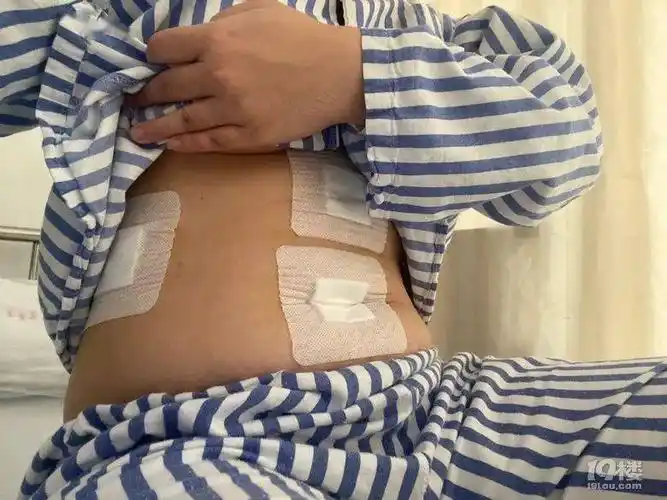 杭州姑娘在肚子上打了3个洞,摘了个器官,手术清醒后最先想到的居然是