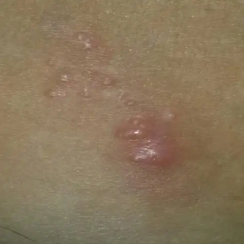 出差走路时,感觉到大腿内侧摩擦得很痛,回家才发现长红点.