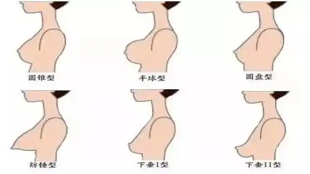 胸型的类别