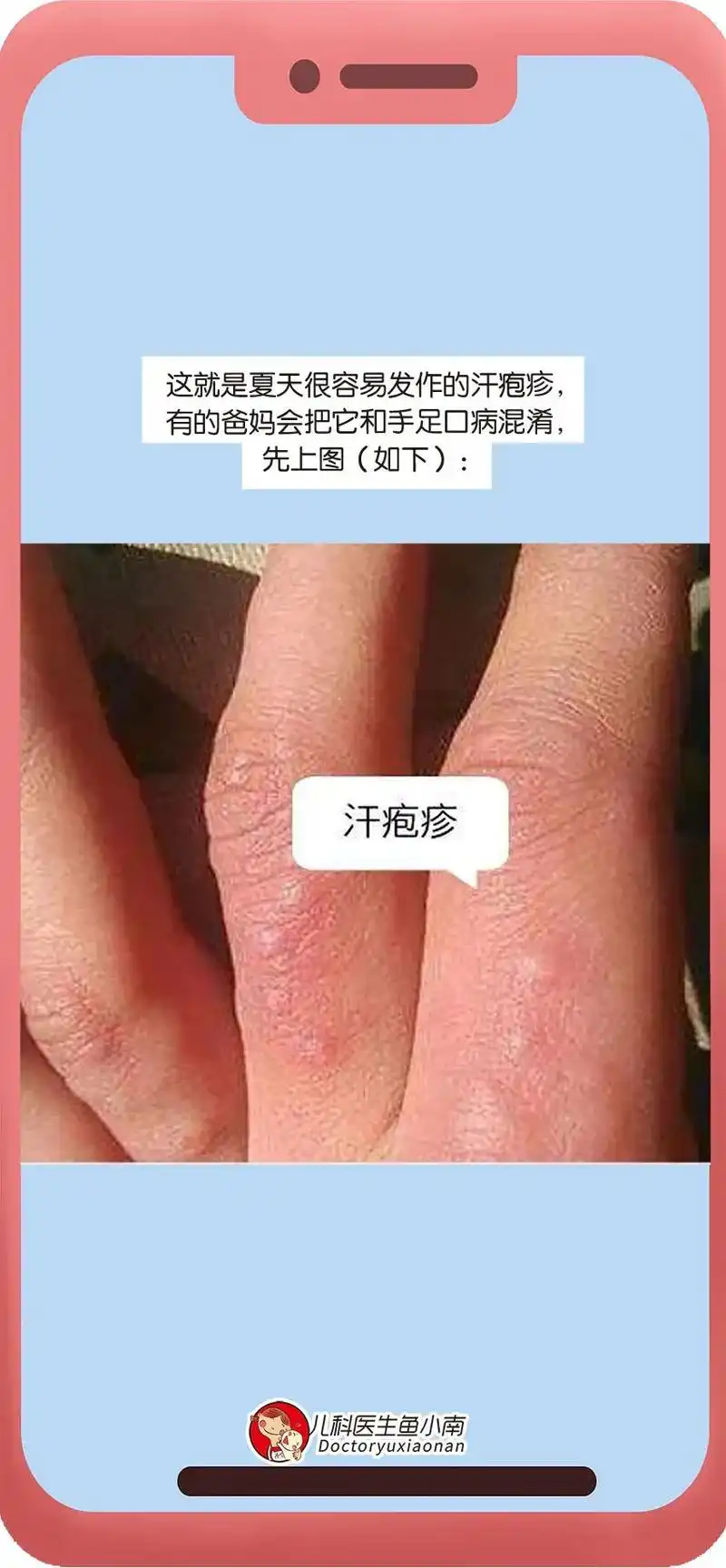 新生儿汗疱疹图片和症状图片及区别(宝宝手指冒出小水泡,非说这是手足