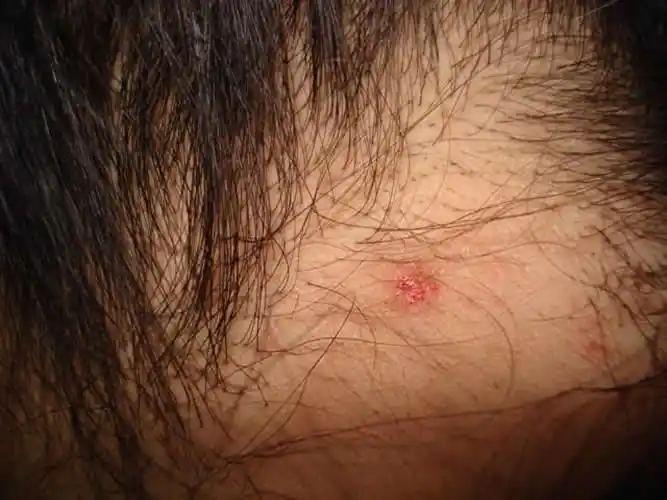 婴儿肛周湿疹图片_有来医生