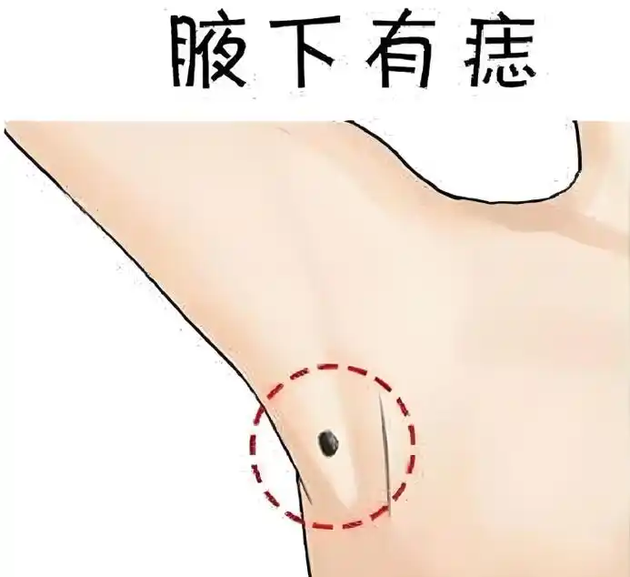 别再乱点痣了,这三个位置长痣,是"福痣",快看看你占了几个