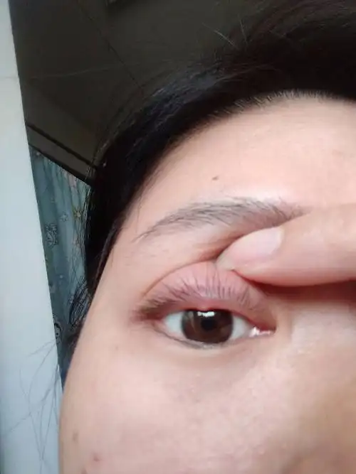 昨天长了麦粒肿,一晚上就红肿的厉害.有些化脓了怎么办?