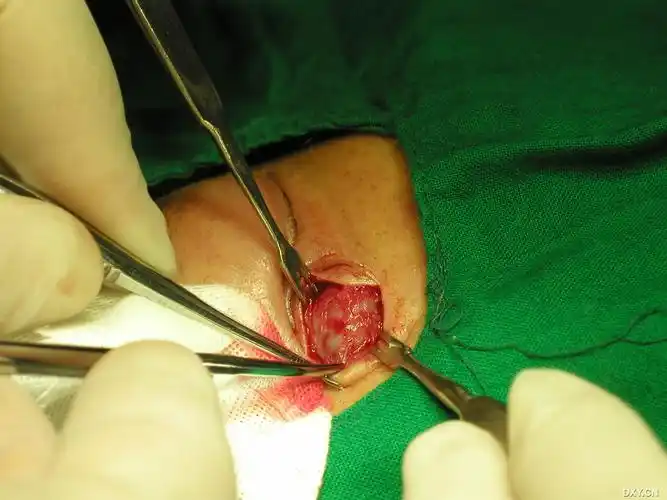 【分享】大泪囊囊肿