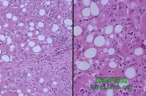 急性酒精性肝炎:mallory小体,肝细胞坏死,胶原沉积,脂肪变