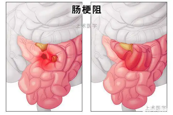 01引起肠梗阻的原因和类型多种多样,肠粘连,肠道异物,肠道肿瘤,寄生虫