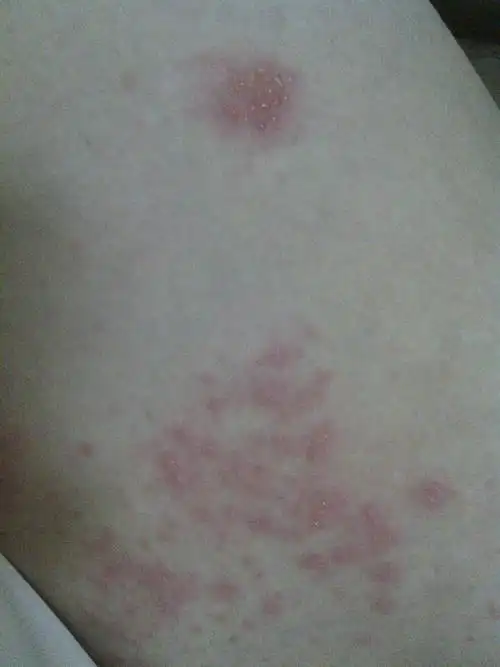 睡了医院的床,大腿内侧就出了这样的米米,亮晶晶的,没痒的感觉.