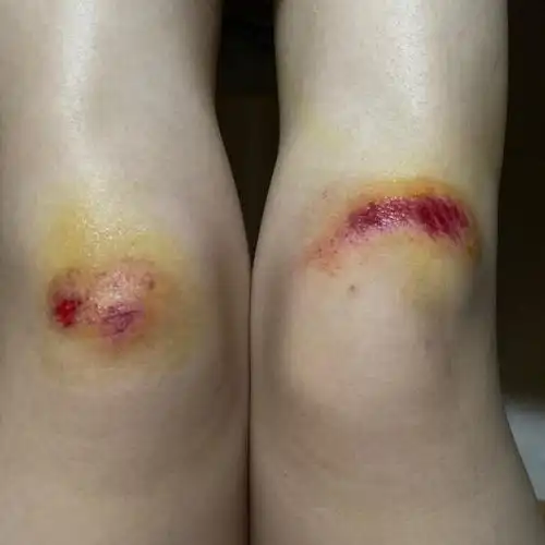 光荣负伤 跑步流血流汗不流泪人可以有事 手机不能有事