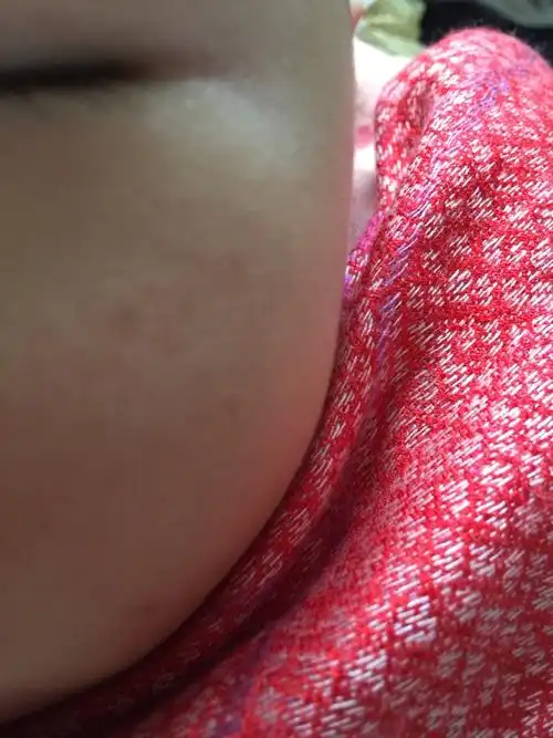 5个月宝宝脸上有些黑点,像痣又像斑,到底是什么?以后会消吗?