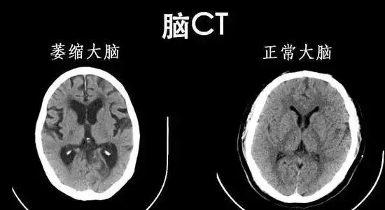 脑萎缩原本是在ct或mri检查时,发现脑组织体积减小和脑室扩大等而命名