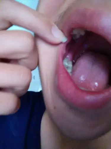 也不知道是不是长智齿了.怎么办