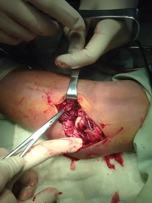 肘关节内侧不稳锚钉缝合