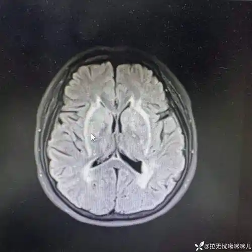 脑白质脱髓鞘改变