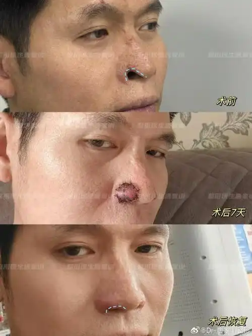 面部大火烧伤后鼻翼缺损修复后#鼻翼缘退缩##鼻翼缘后缩矫正##鼻翼缘