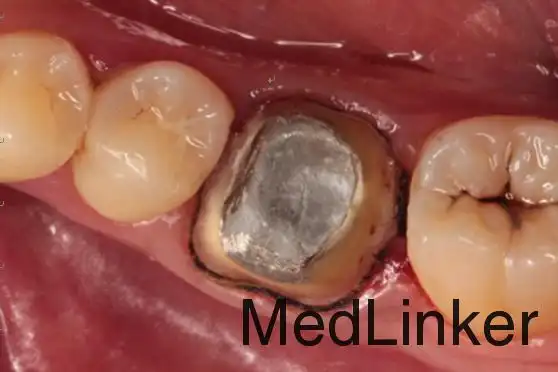 桩核冠修复,返工