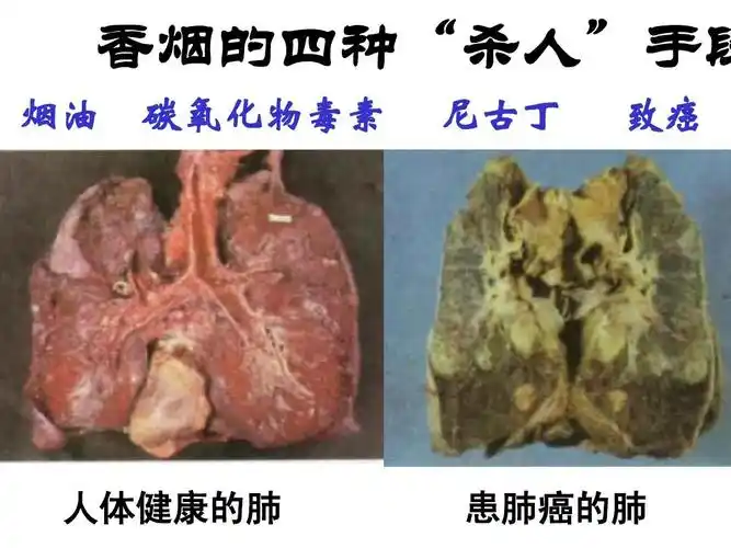 香烟的四种"杀人"手段 烟油 碳氧化物毒素 尼古丁 致癌 人体健康的肺