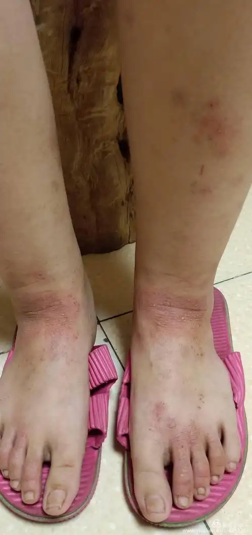 重度湿疹一例(河北中医学院侯仙明教授皮肤病验案系列) - 美篇