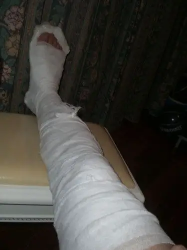 髌骨骨折石膏固定的方法图片