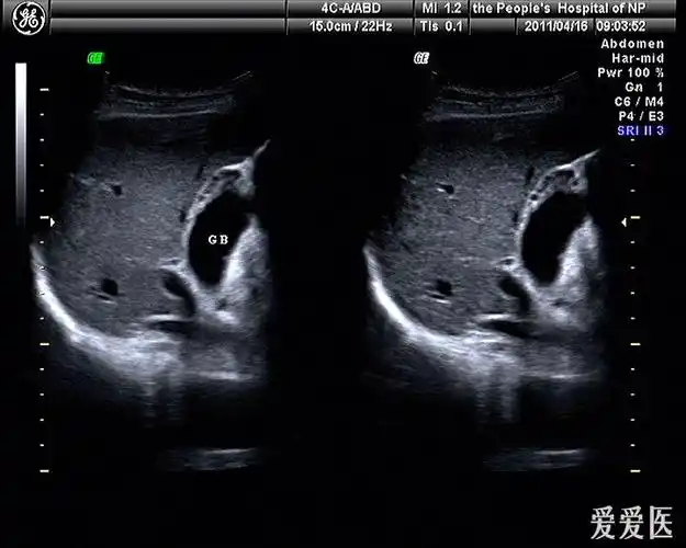 胆囊腺肌症可能,请指教 - 超声医学讨论版 - 爱爱医医学论坛