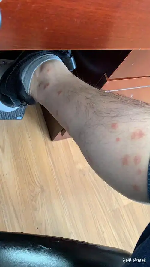 被小咬(一种黑色小飞虫)咬了痛痒难当,怎么破? - 知乎