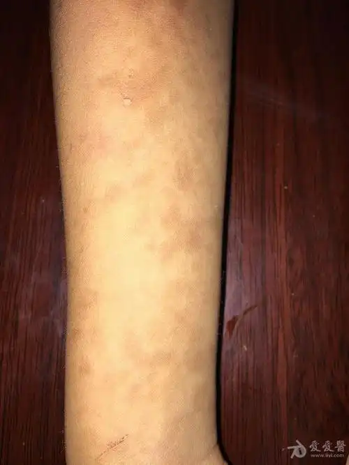 病例讨论手臂散在咖啡色斑