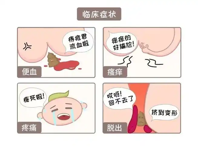 科普丨孕期遇痔疮又痛又尴尬