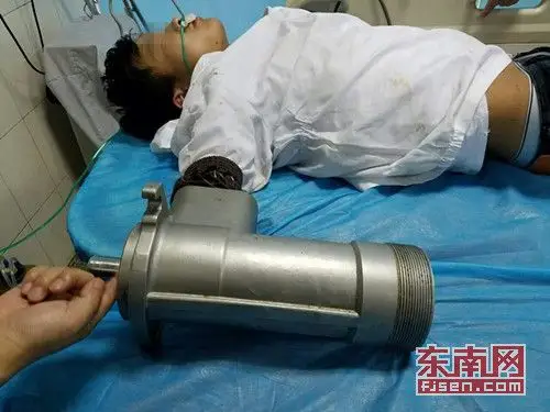 福州一男子被绞肉机"咬"手"不松口" 小臂前半部分被绞烂