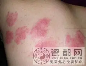 飞蛇病,一般能传染给小孩子.儿童得的水痘就是这种病毒引起的.