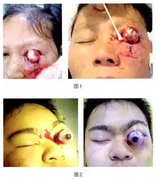 左眼球疼是怎么回事(左眼球疼是怎么回事一按就疼)