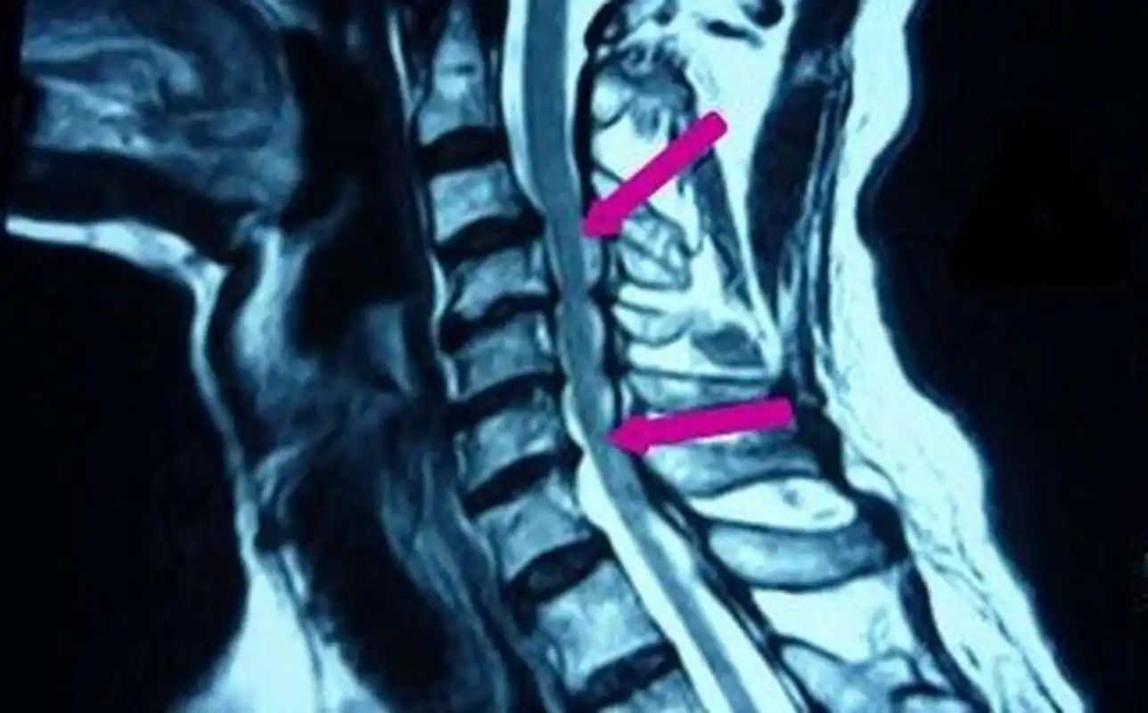 临床上常可遇到突发性颈椎间盘突出症,而且大多数是以瘫痪为首发症状