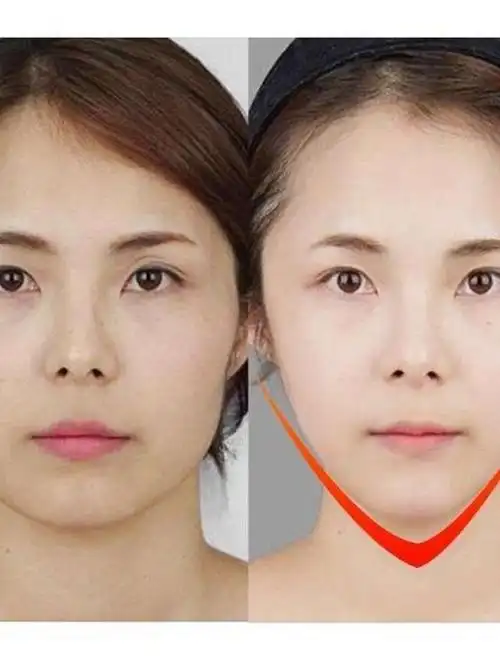 28岁女子多次打瘦脸针导致咬肌无力,这3类人群别瞎打!