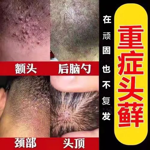 头皮癣专用药膏治疗头部牛皮癣银屑藓头屑头痒真菌感染特效止痒膏