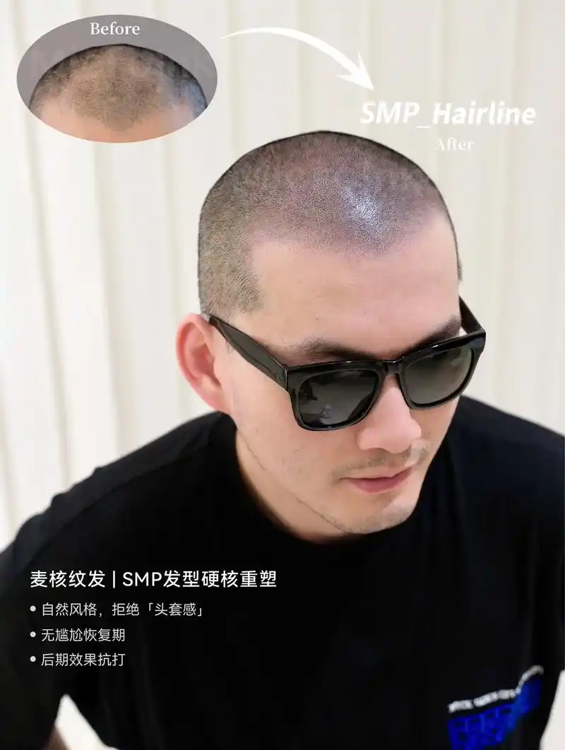 今天的客人脱发问题主要集中在头顶 - 抖音