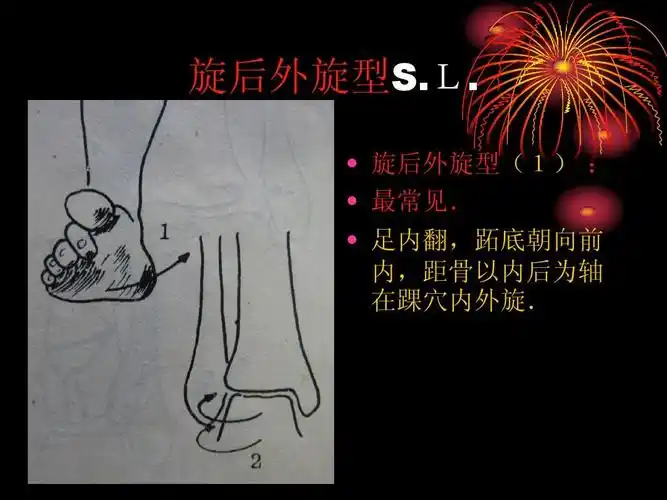 旋后外旋型s.l.   旋后外旋型(1) :   最常见.