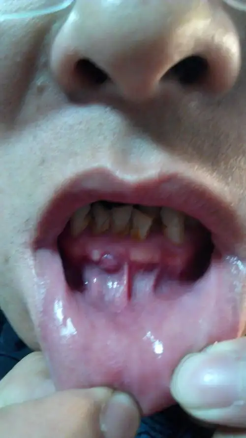 关于慢性根尖周炎