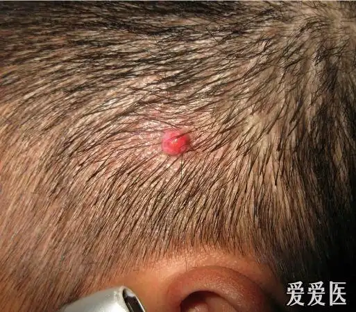 头皮化脓性肉芽肿