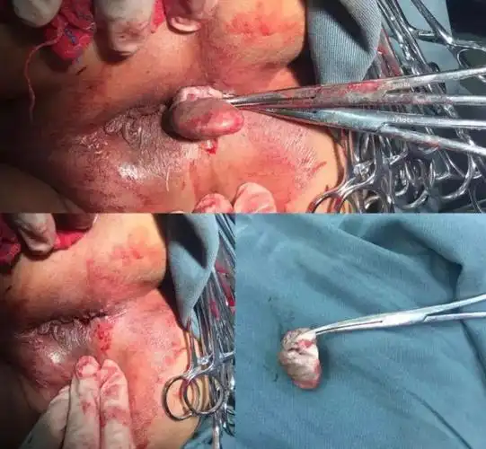 女性外痔疮初期图片_有来医生