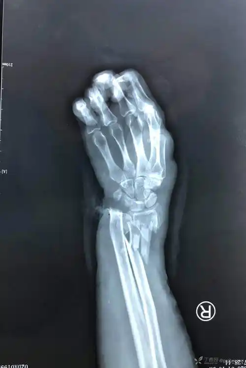 开放性尺桡骨远端粉碎性骨折