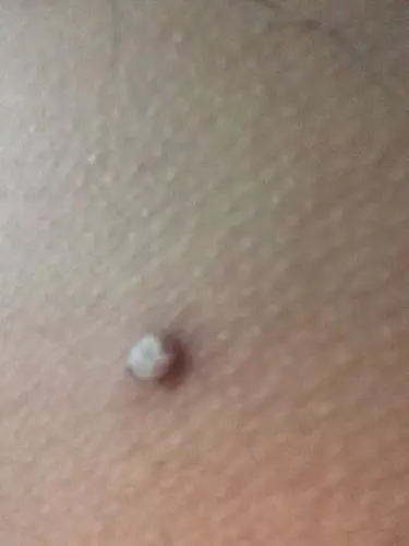 请问各位我这是什么啊 长在大腿外侧 看着已经开花了