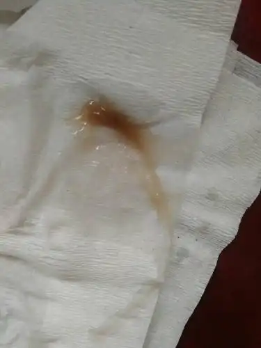 这样的白带是什么原因?