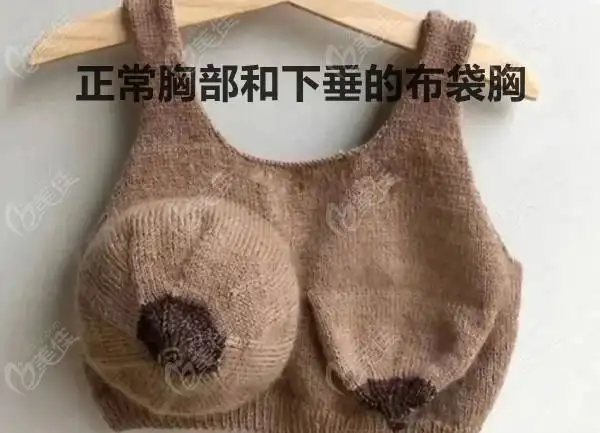 布袋胸下垂厉害做乳房悬吊术的同时可不可以加上脂肪填充改善呀