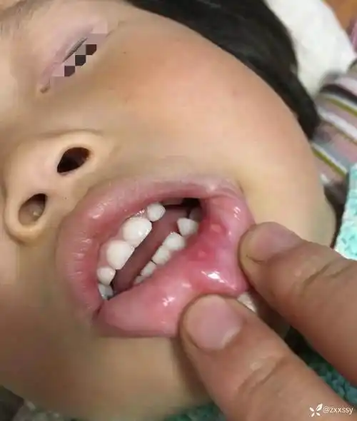 典型小儿手足口皮疹