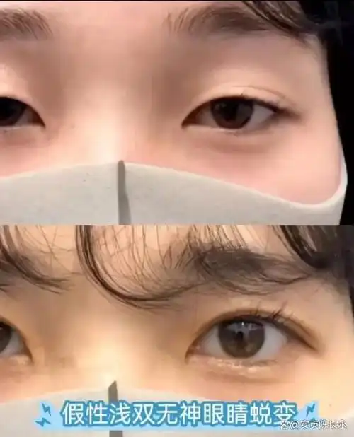 有的人是天生单眼皮,有的是小内双眼,还有一种很少见就是假性双眼皮