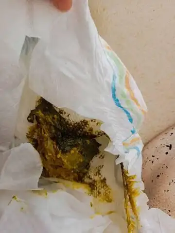 婴儿喂奶粉的拉这种屎正常吗 ?