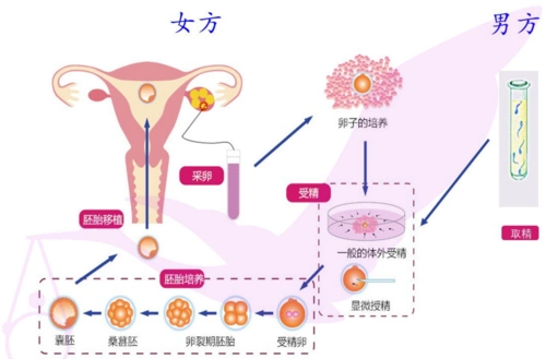 信不信由你不用憋尿也可以轻松准确地进行胚胎移植