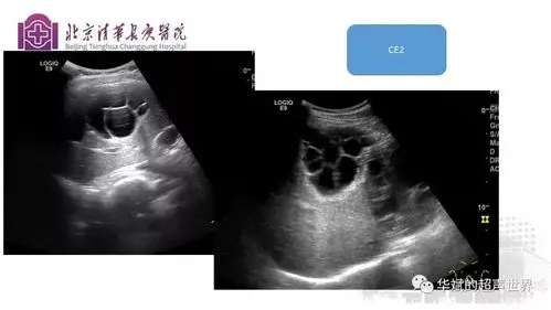 文献与病例学习肝包虫病的超声诊断