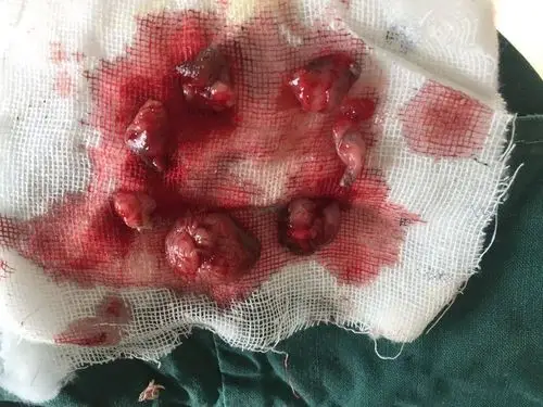 重度脱垂性混合痔 - 好大夫在线