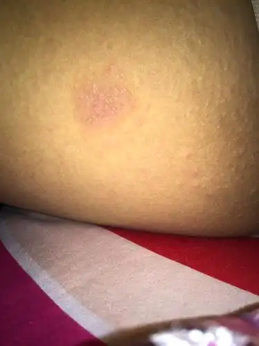 大腿内侧突然起来一推疙瘩,.怎么回事啊?现在哺乳期.没出去洗澡过.按