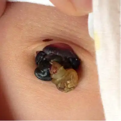 宝宝的肚脐这样了,没事吧?