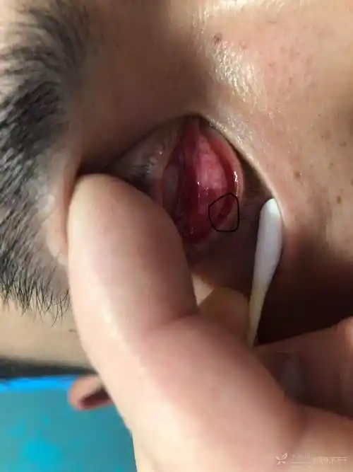 30岁男性结膜结石导致流泪眼涩